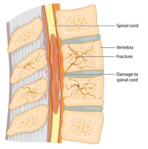 Spinal fracture surgery treatment and surgeon in Mumbai – D Spine