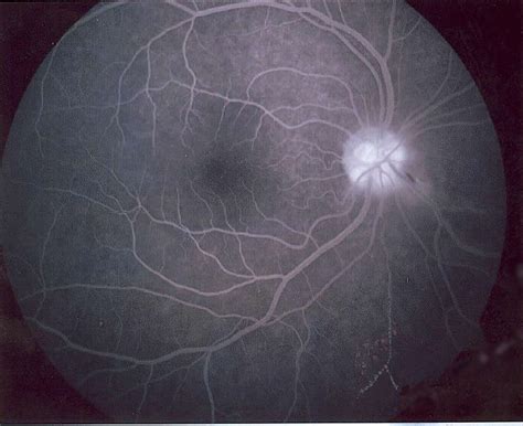 Fluorescein angiography. Causes, symptoms, treatment Fluorescein angiography