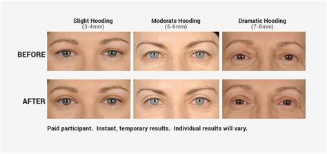 Alternative Treatments for Droopy Eyelids | Contours Rx | Eyelid lift ...