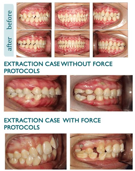 Clinical case: before and after - Whitesmile Clear Aligner - The Clear and Affordable Invisible ...