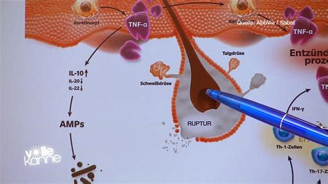 Acne inversa – Was hilft gegen die Hauterkrankung? - ZDFmediathek