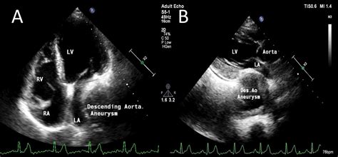 Cureus | Cardiovocal Syndrome Secondary to Thoracic Aortic Aneurysm: An Old Sign Revisited