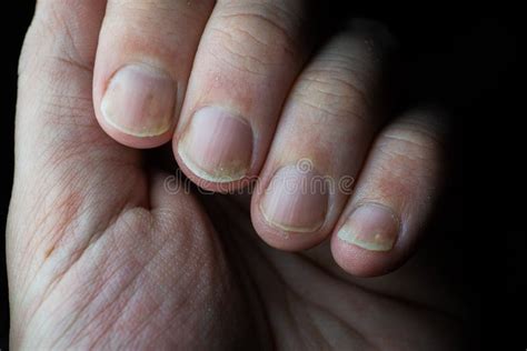 Psoriasis is an Autoimmune Disease that Affects the Nail and Skin. Close Up of Psoriasis Nail on ...