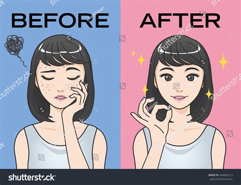 Acne Treatment Before After Cartoon Illustration Stock Vector (Royalty Free) 444682213 ...