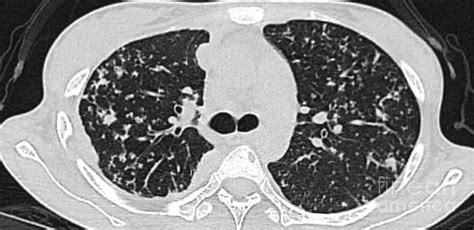 Miliary Tuberculosis Photograph by Rajaaisya/science Photo Library ...