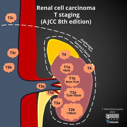 Renal cell carcinoma (TNM staging) | Radiology Reference Article ...