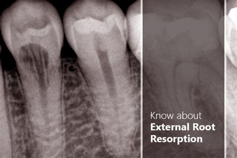 Internal And External Root Resorption