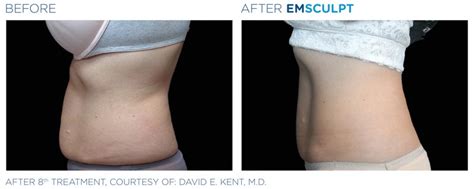 Emsculpt Body Toning | Dr. Parson Plastic Surgery and Skin Center