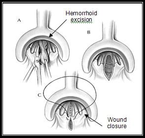 General Surgery - Hemorrhoidectomy