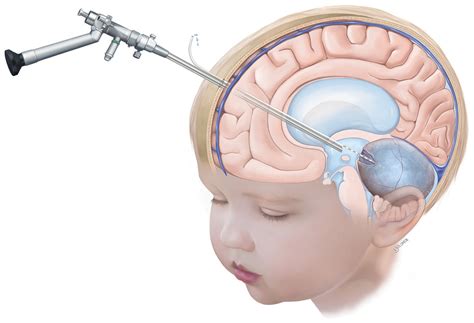 Arachnoid Cyst