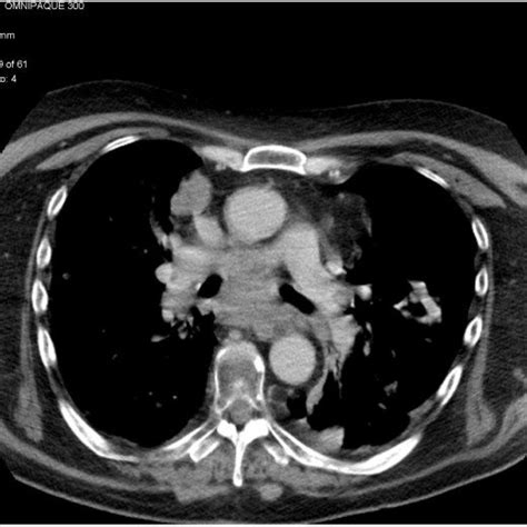 Chest CT showing disease response and a 50% left-sided pneumothorax.... | Download Scientific ...