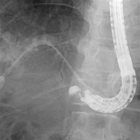 Schema of Roux-en-Y hepaticojejunostomy and EUS-guided approach to the... | Download Scientific ...