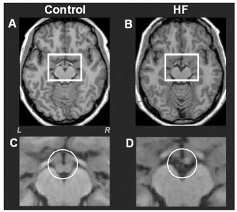 Mammillary Bodies Mri