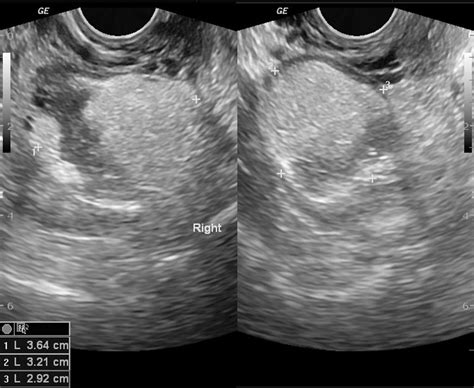 Dermoid Ovarian Cyst Ultrasound