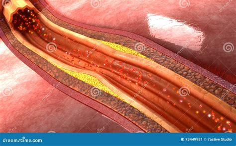 Coronary artery plaque stock image. Image of vessels - 73449981