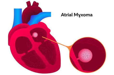 Causes of myxoma - MEDizzy