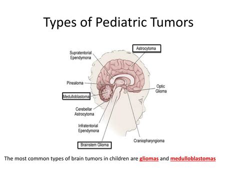 PPT - Pediatric Brain Tumors PowerPoint Presentation, free download ...