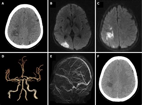 Hemorrhagic transformation after acute ischemic stroke caused by polycythemia vera: Report of ...