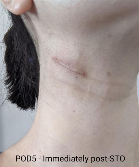 Lymph Node Lump On Neck