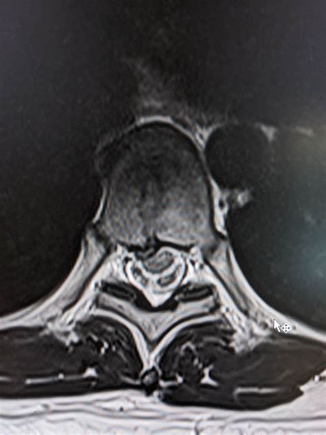 T7 bulging disc - treatment options? : r/Radiology