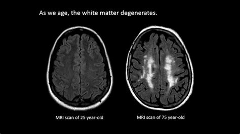 The Aging Brain - Week by Week Time Lapse - YouTube