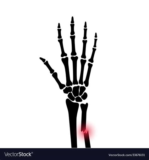 Fracture x ray concept Royalty Free Vector Image