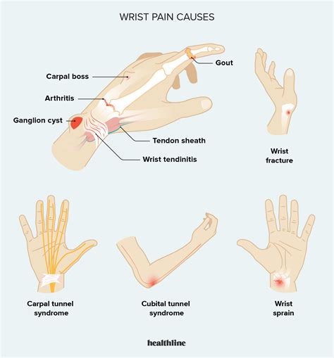 Ulnar Wrist Pain Causes