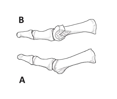 Distal chevron osteotomy. Axial hallux valgus deformity (A) is... | Download Scientific Diagram