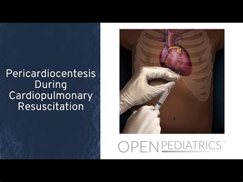 "Pericardiocentesis During Cardiopulmonary Resuscitation" by Dr. Traci Wolbrink for ...