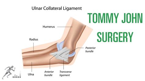 Tommy John surgery for a UCL injury of the elbow - YouTube