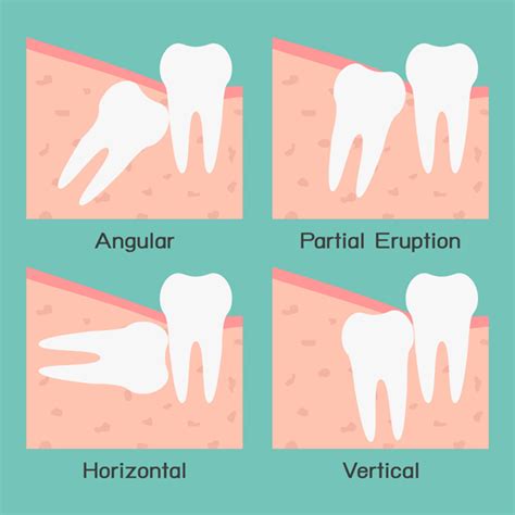ฟันคุด (Impacted Tooth) - คลินิกทันตกรรมโลตัสอ่อนนุช จัดฟัน ฟอกสีฟัน