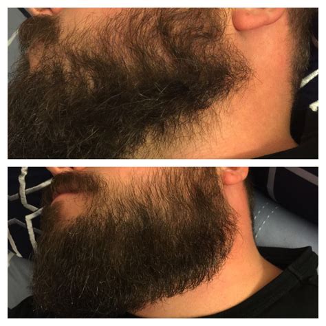 Before and after using world famous Lumberjack's beard oil | Beard oil, Beard growth, Beard balm