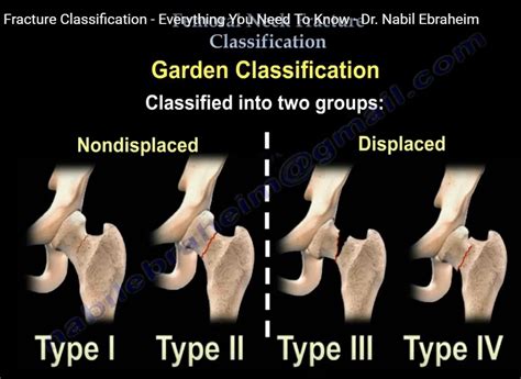 Femoral Neck fracture classification — OrthopaedicPrinciples.com