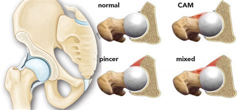 Femoroacetabular Impingement (FAI) - CNOS