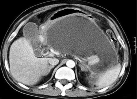 CT scan showing large pancreatic pseudocyst in the lesser sac. CT,... | Download Scientific Diagram