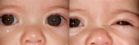 glaucoma in babies causes - Beula Mays