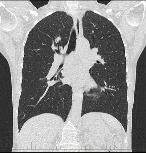 Chest CT Scan - Melbourne Radiology