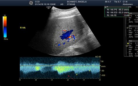 Acute portal vein thrombosis after liver transplant presenting with subtle ultrasound ...