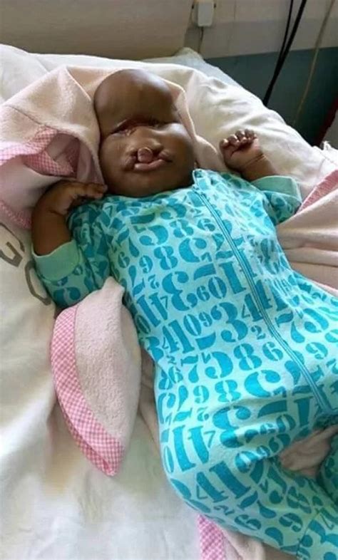 Baby born with severe facial deformities in Kenya shunned by parents ...