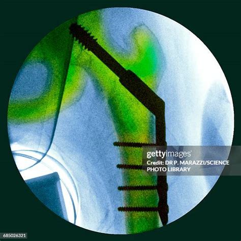 Hip Fracture X Ray Photos and Premium High Res Pictures - Getty Images