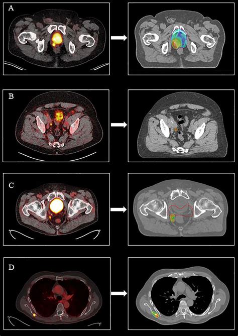 Frontiers | PET/CT-Based Salvage Radiotherapy for Recurrent Prostate ...