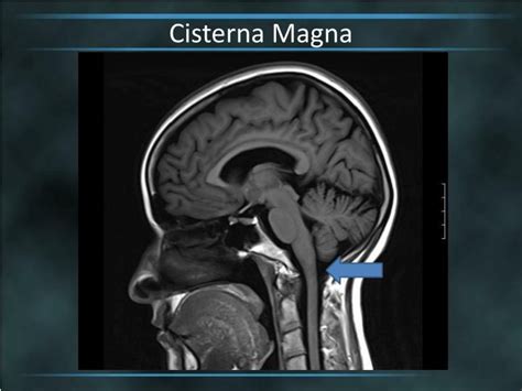 Brain Cisterns | Cistern, Brain, Vertebral artery