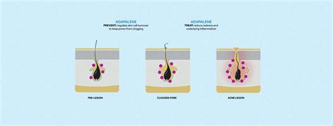 What is Adapalene Topical Retinoid for Acne? | Differin Gel