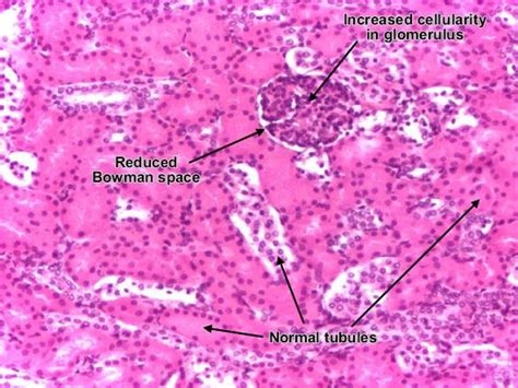 poststreptococcal acute diffuse proliferative glomerulonephritis (hypercellular) | Histopath ...