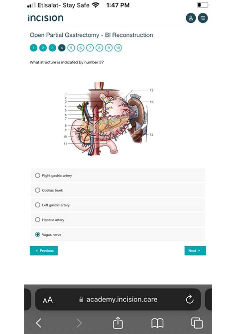 Open Partial Gastrectomy 3 - Internal Medicine - Studocu