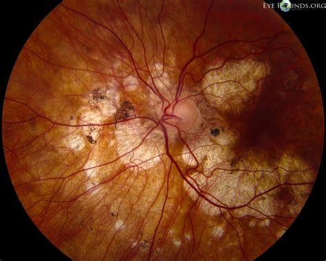 Atlas Entry - Serpiginous choroidopathy