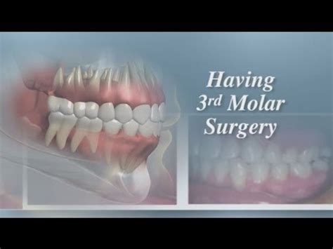 Having Third Molar Surgery - YouTube