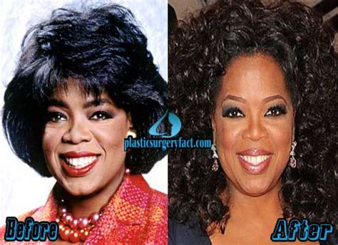 Oprah Winfrey Nose Job Before And After Photo | Plastic surgery ...