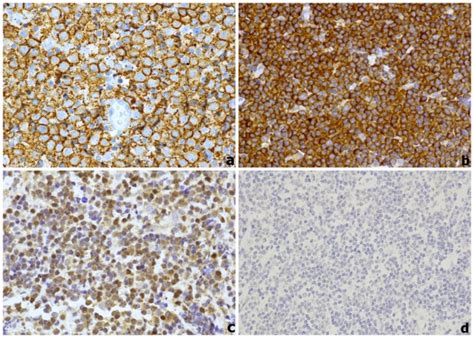 CD20 and Bcl10 immunohistochemical expression; (a) Diffuse CD20 ...