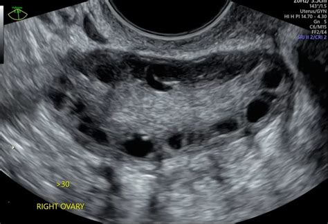 Polycystic Ovaries (PCOS) Ultrasound Sydney | USC